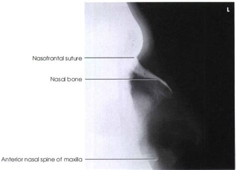 Nasal bones (lateral view) .